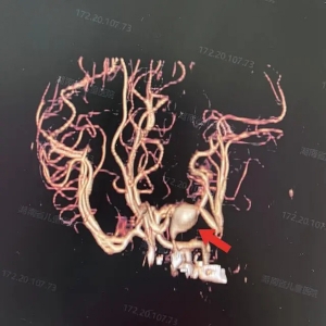 全国最低龄！16天新生儿颅内长出巨大动脉瘤，切除！
